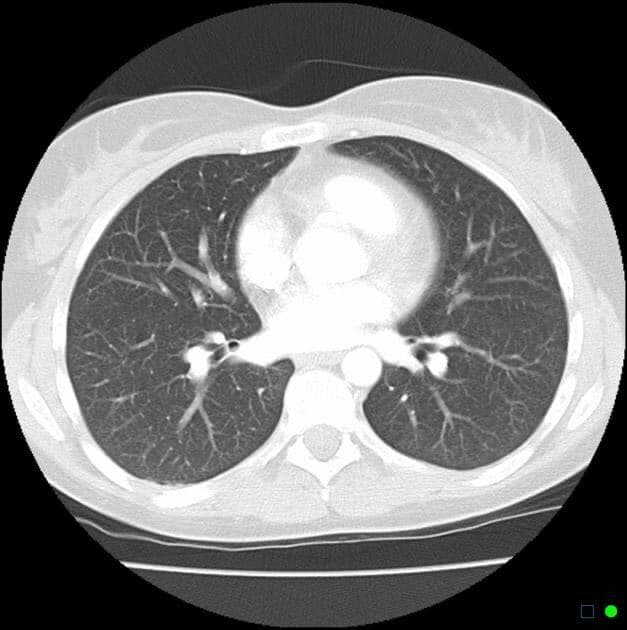 Chest CT scan