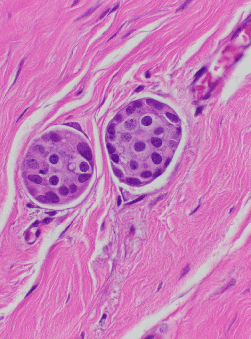 Histology — lymph node biopsy